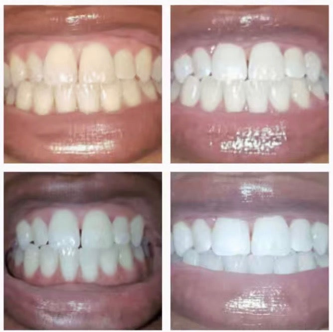 Caloria Teeth Whitening Pen