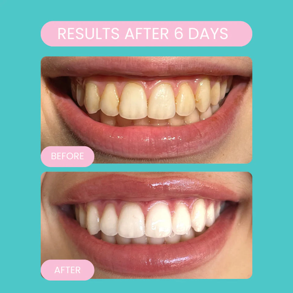 Caloria Teeth Whitening Pen